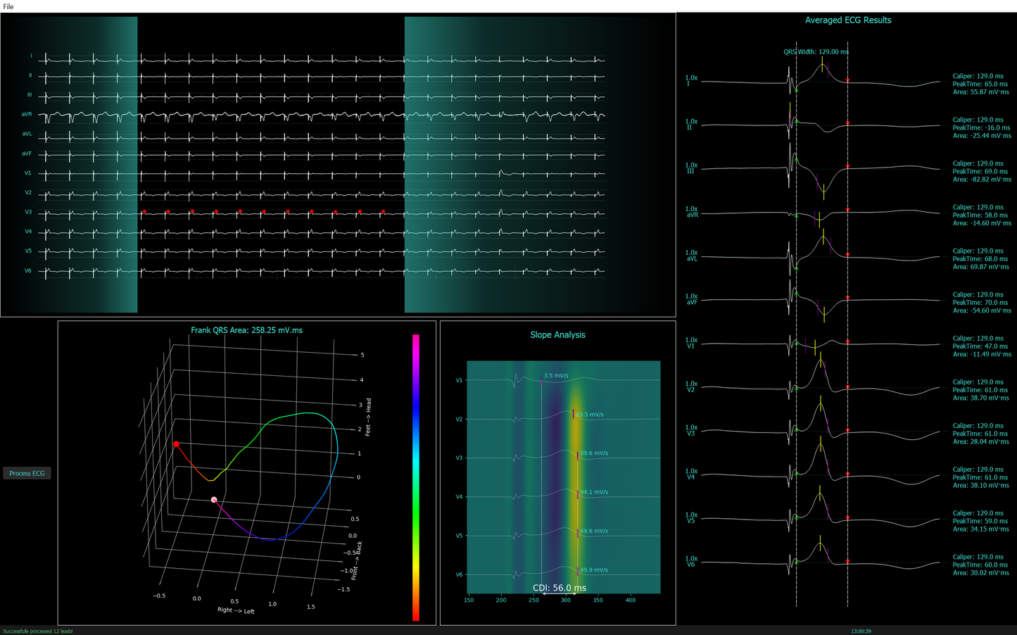 SyncView v0.1 Advanced ECG Analysis - RESEARCH for MAC